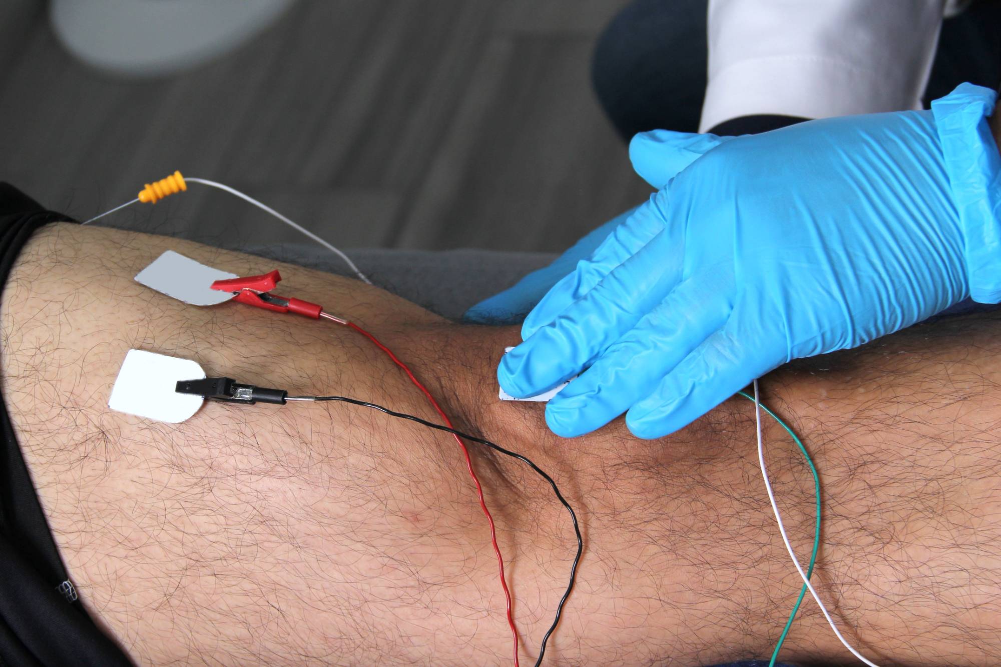 A person wearing blue gloves applies electrodes with wires to a patient's hairy leg, likely for physical therapy or electrical stimulation treatment.