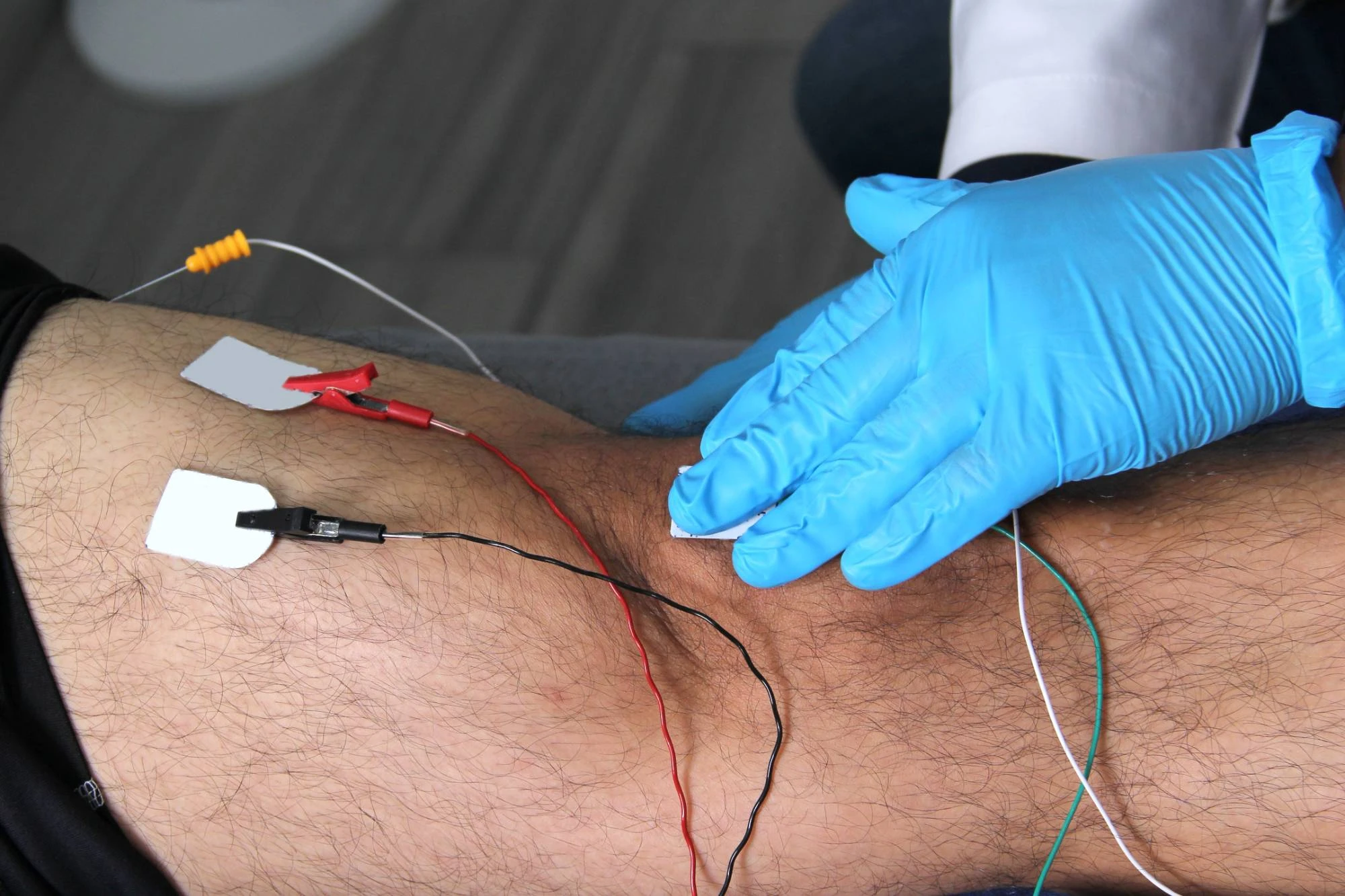 A person wearing blue gloves applies electrodes with wires to a patient's hairy leg, likely for physical therapy or electrical stimulation treatment.